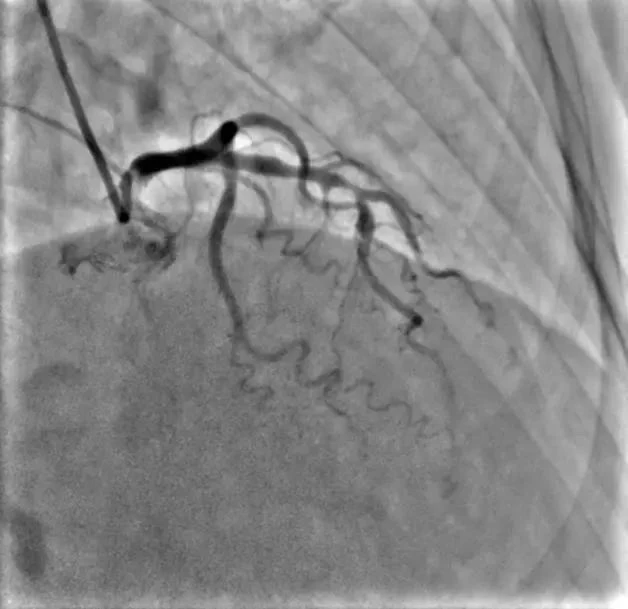 angiography machine
