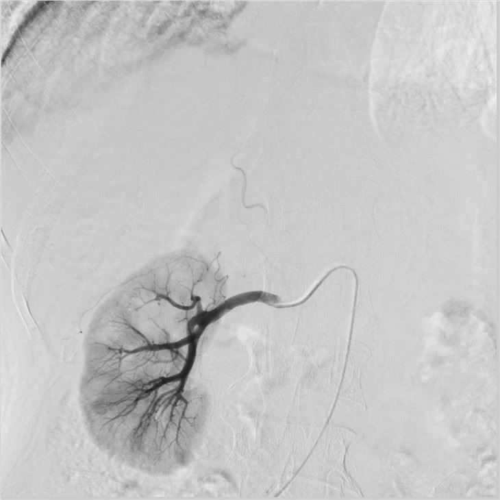 Floor-mounted Single Plane Medical X-ray Angiography System